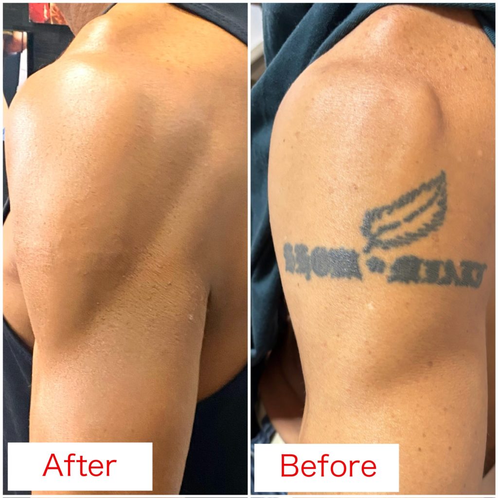 タトゥーカバーアップ