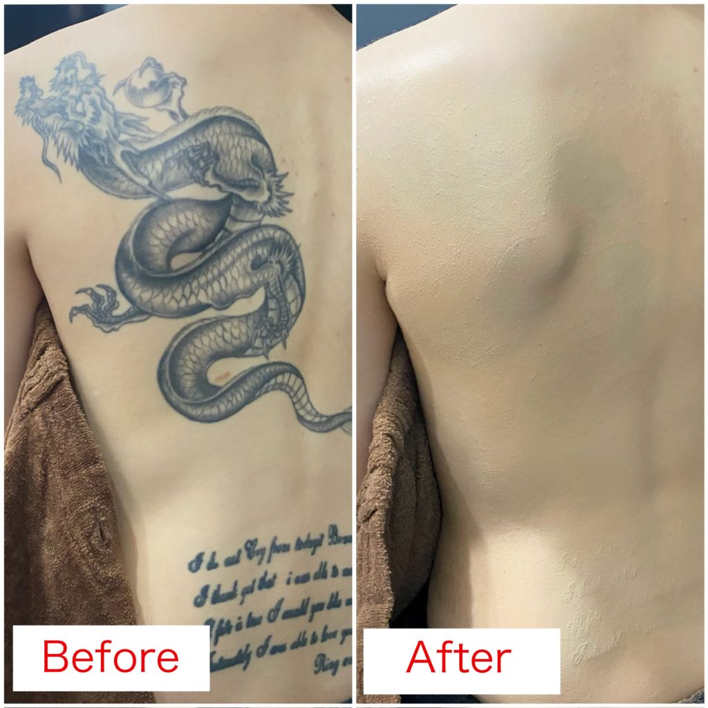 タトゥーカバーアップ